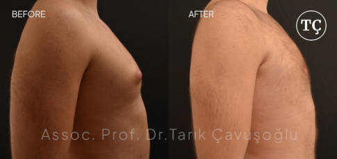 Gynecomastia Before After