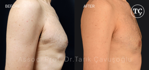 Gynecomastia Before After