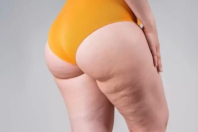 Advantages of Having Lipedema Surgery in Turkey