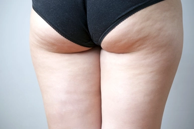Can VaserLipo Help with Cellulite?