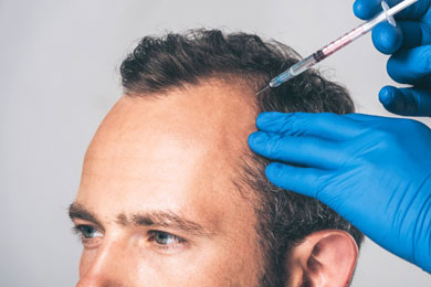 Does Stem Cell Therapy Work on Hair Loss?