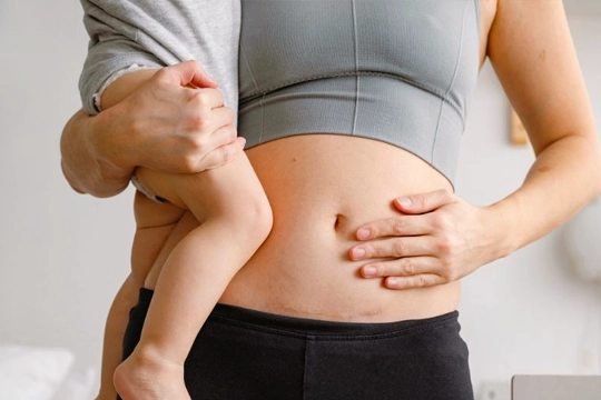 Doğum Sonrası Karın Germe Ne Zaman Yapılmalı?