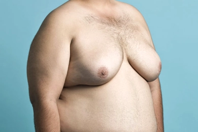 How to Know If You Have Gynecomastia?