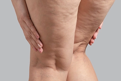 How to Know If You Have Lipedema: A Complete Guide