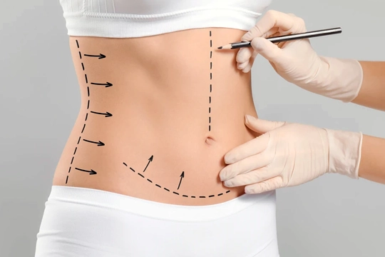 Liposuction ve Karın Germe Arasındaki Farklar