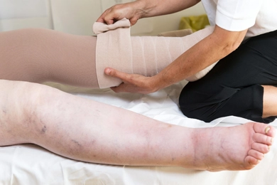 Understanding the Distinctions Between Lipedema and Lymphedema