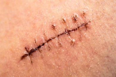 What Can Be Done to Prevent Stitch Scars?