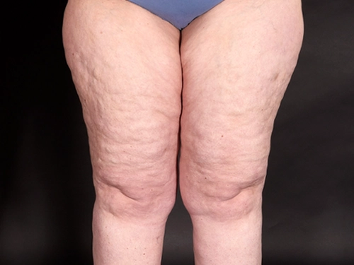 In-depth Look At Lipedema