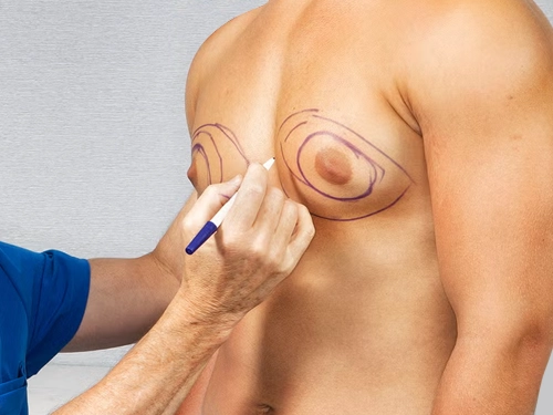 Jinekomasti Ameliyatı Fiyatları 2026