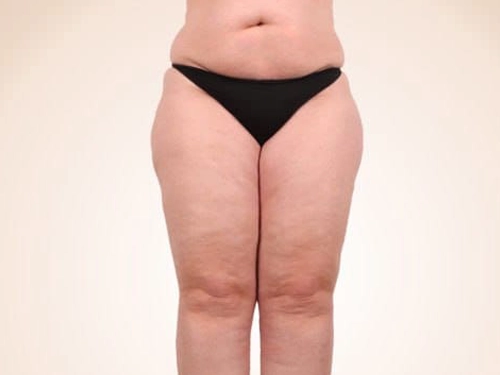 Lipödem Ameliyatı Kimlere Uygundur?