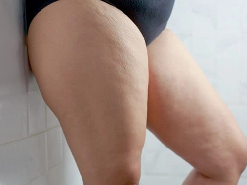 Lipödem Ameliyatı Öncesi Ne Yapılmalı?