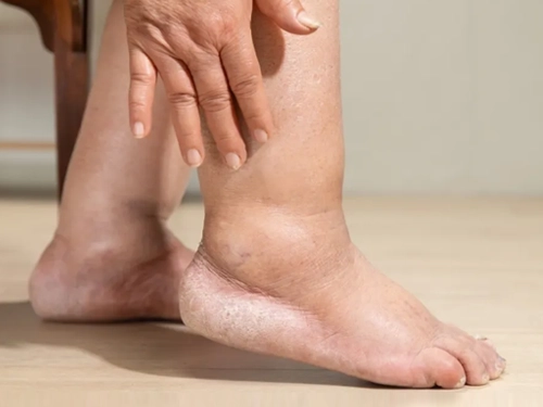 Lipödem Ameliyatı Sonrası Şişlik