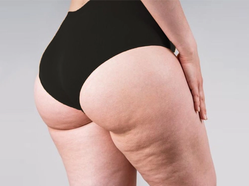 Lipödem Belirtileri