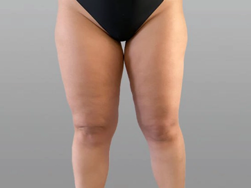 Lipödem En Çok Hangi Hastalıklarla Karışır?