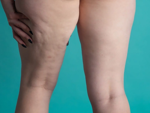 Lipödem ile Lenfödem Nasıl Ayırt Edilir?