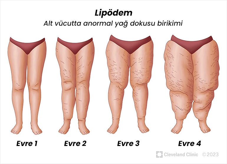 Lipödem Evreleri