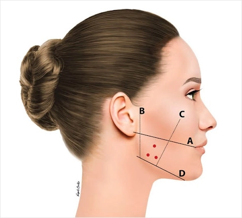 Masseter Botoks